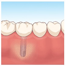 人工の歯を装着～インプラント治療完了
