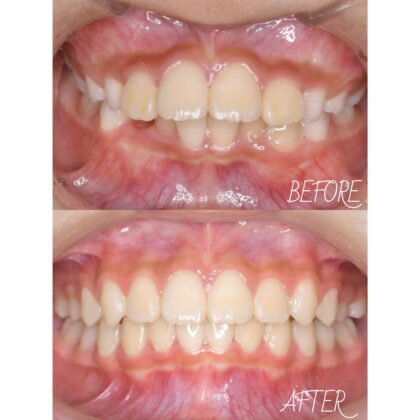 前歯が出ている、がたつきが気になる…