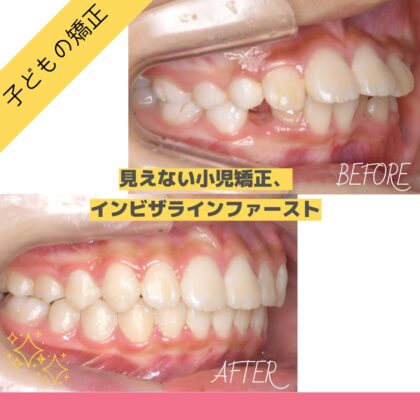 前歯が出ている、がたつきが気になる…