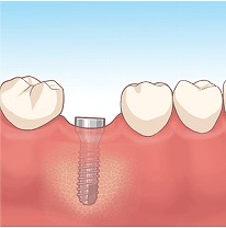 インプラント埋入手術（１次オペ）