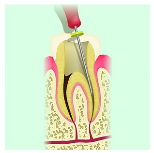 ファイルで感染した神経をかき出し綺麗にする