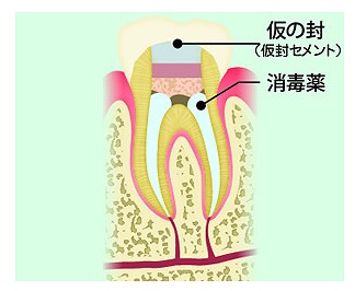 消毒薬を詰めて仮封（根管貼薬）