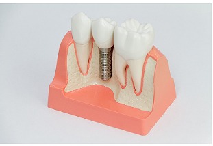 インプラントカウンセリング（約30分～1時間）