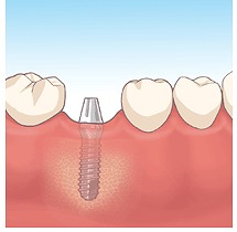 インプラント埋入手術（２次オペ）