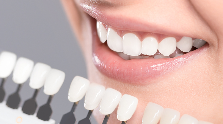 ホワイトニング