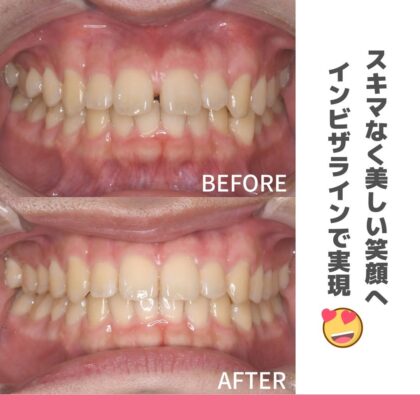 すきっぱが気になる、前歯の裏の歯ぐきを噛んで痛い