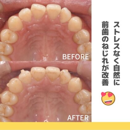 前歯が少しねじれているのが気になる。