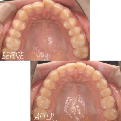 前歯のねじれが気になる