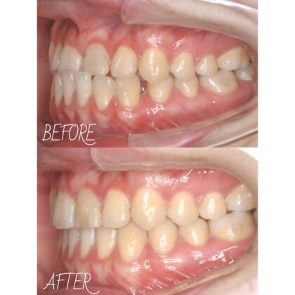 受け口が気になる