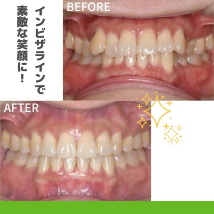 前歯、ガタつきが気になる…