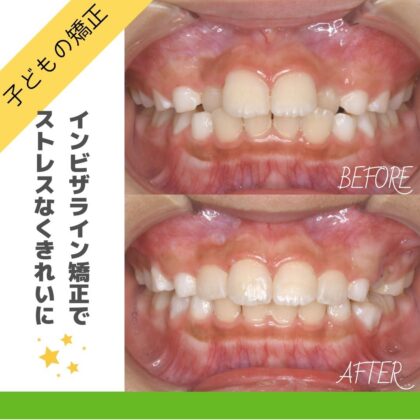 前歯がガタガタしていることが気になる