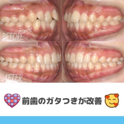 前歯のねじれが気になる