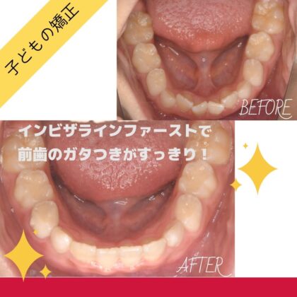 前歯のガタガタが気になる