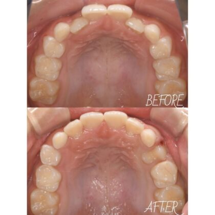 前歯がガタガタしていることが気になる