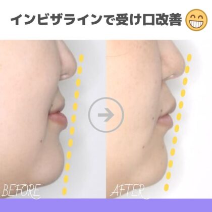 受け口が気になる