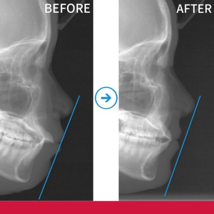 前歯が出ていることが気になる