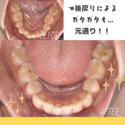 矯正後の後戻りをなおしたい