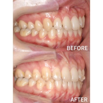 前歯が少しねじれているのが気になる。