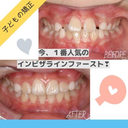 前歯が内側から生えてきた