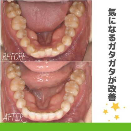 前歯のガタガタが気になる