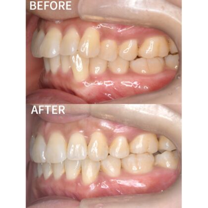 前歯、ガタつきが気になる…