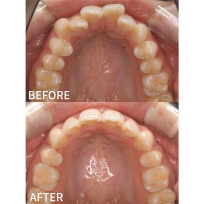 ガタガタ、前歯が出ていることが気になる