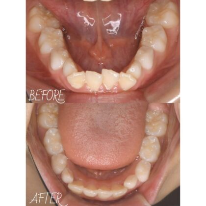 前歯のガタつきが気になる