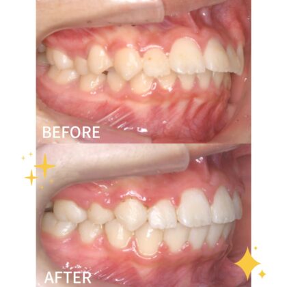 前歯が出ていることが気になる