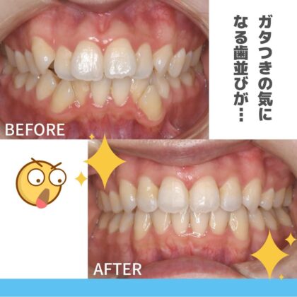 ガタガタ、前歯が出ていることが気になる