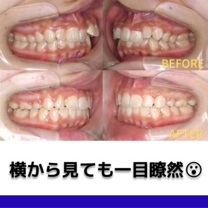 ガタガタ、出っ歯、かみ合わせが深い