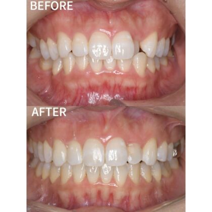 インビザラインでの矯正治療