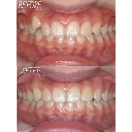 下の歯が1本足りない、八重歯のガタつきが気になる