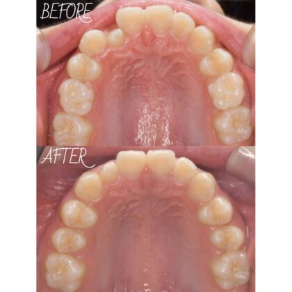 ガタガタした歯並びが気になる…