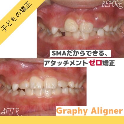 前歯が裏側から生えてきた