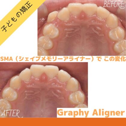下の歯が1本足りない、八重歯のガタつきが気になる