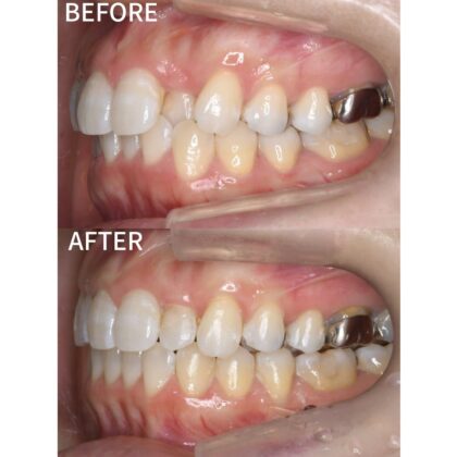 インビザラインでの矯正治療